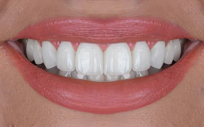 Cosmetic Dentistry & Smile Designing